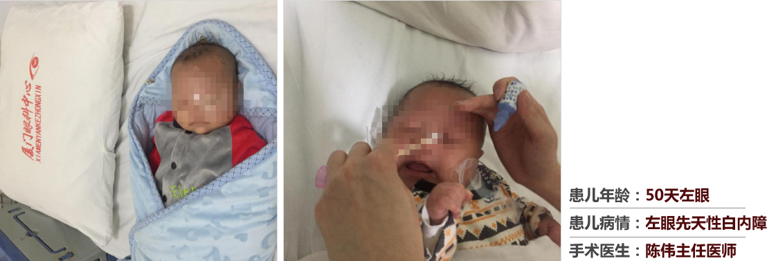 患兒年齡：50天左眼，患兒病情：左眼先天性白內(nèi)障，手術(shù)醫(yī)生：白內(nèi)障科陳偉主任醫(yī)師