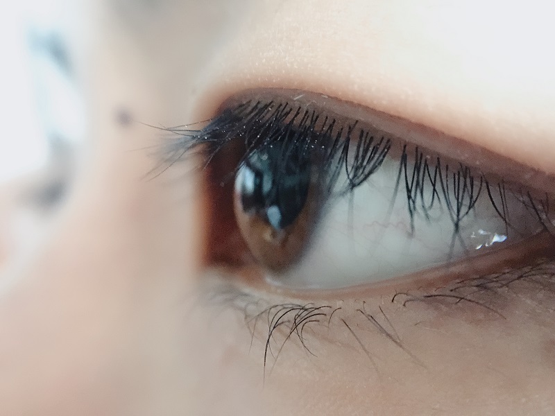 上眼皮為什么會下垂？上瞼下垂是怎么引起的？