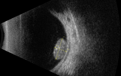 視網(wǎng)膜母細(xì)胞瘤分類(lèi)