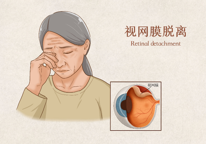 視網(wǎng)膜脫離手術多長時間