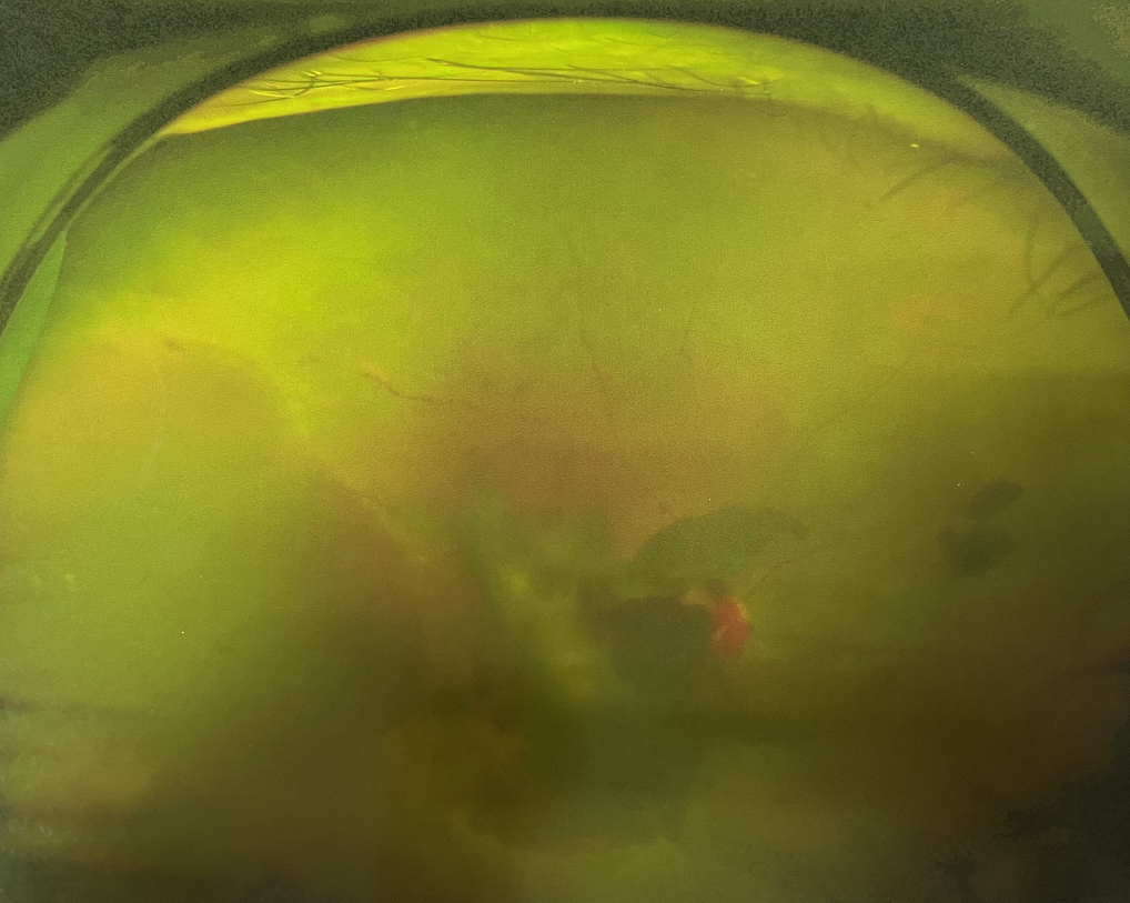 糖尿病視網膜病變