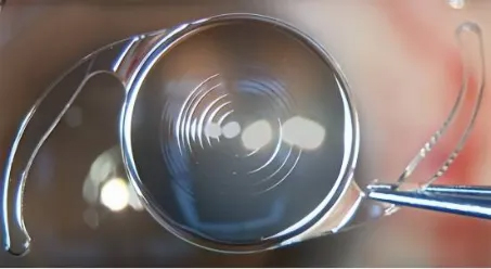 白內障多焦點人工晶體